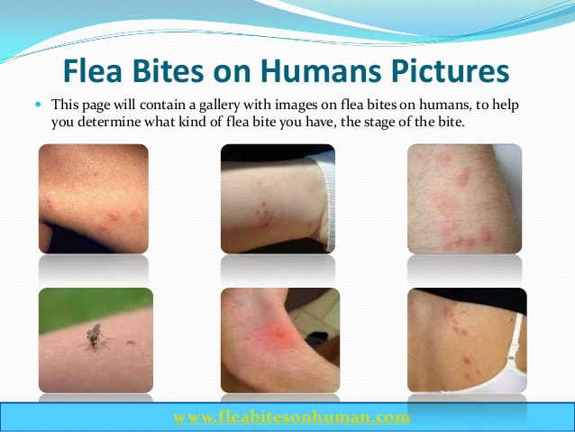 Scabies Mite Bites On Humans